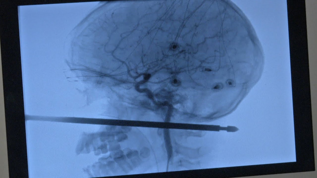 Pincho para carne atraviesa la cabeza de un niño, pero sobrevive «milagrosamente»