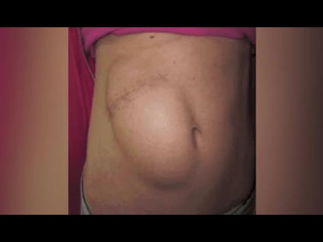 Tenía dolores y le encontraron casi 12,000 piedras en el estómago