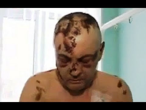 Los terribles efectos de la llamada “droga carnívora”