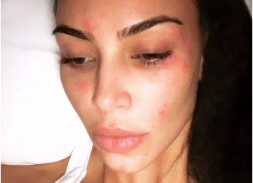 Kim Kardashian posa sin maquillaje para enseñar la psoriasis de su rostro
