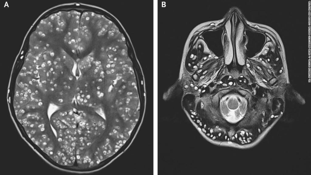 Adolescente murió por infestación de huevos de tenia en el cerebro