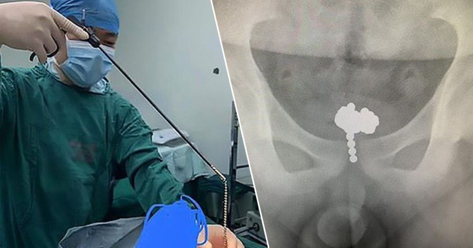 Se introduce 70 bolas magnéticas por el pene y deben operarle