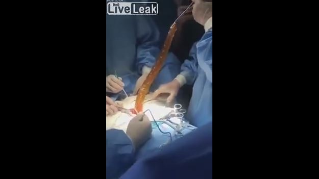 Cirujanos extraen enorme consolador del estómago de una mujer