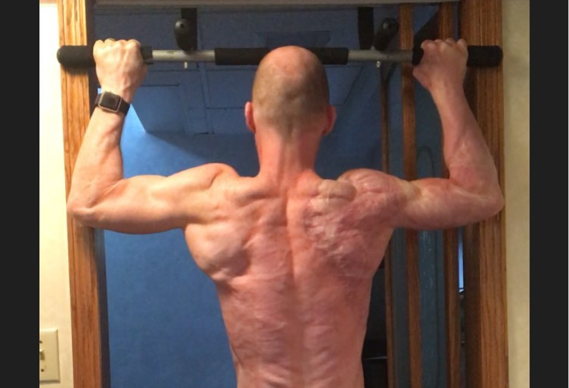 Bacteria come-carne devora parte de su cuerpo, pero no le impide ser atleta