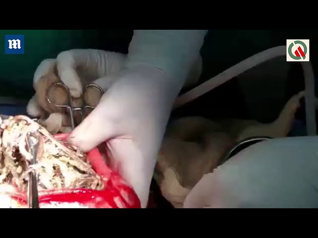 Encuentran joyas en su estómago por valor de $63,000 dólares