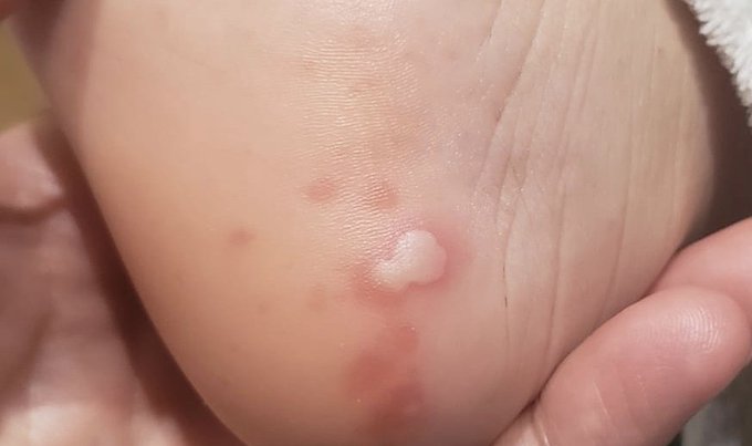 Identifican cinco lesiones en la piel que han aparecido en pacientes con covid-19