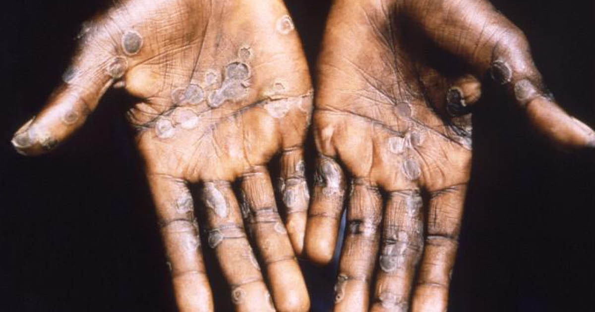 Se encuentra un caso de viruela del mono en Massachusetts